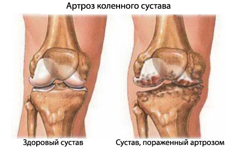 Артроз суставов: лечение, симптомы. Степени артроза.