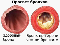 Как лечить хронический бронхит: полезная информация для пациентов